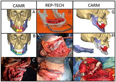 Surgical Margins After Computer-Assisted Mandibular Reconstruction: A Retrospective Study